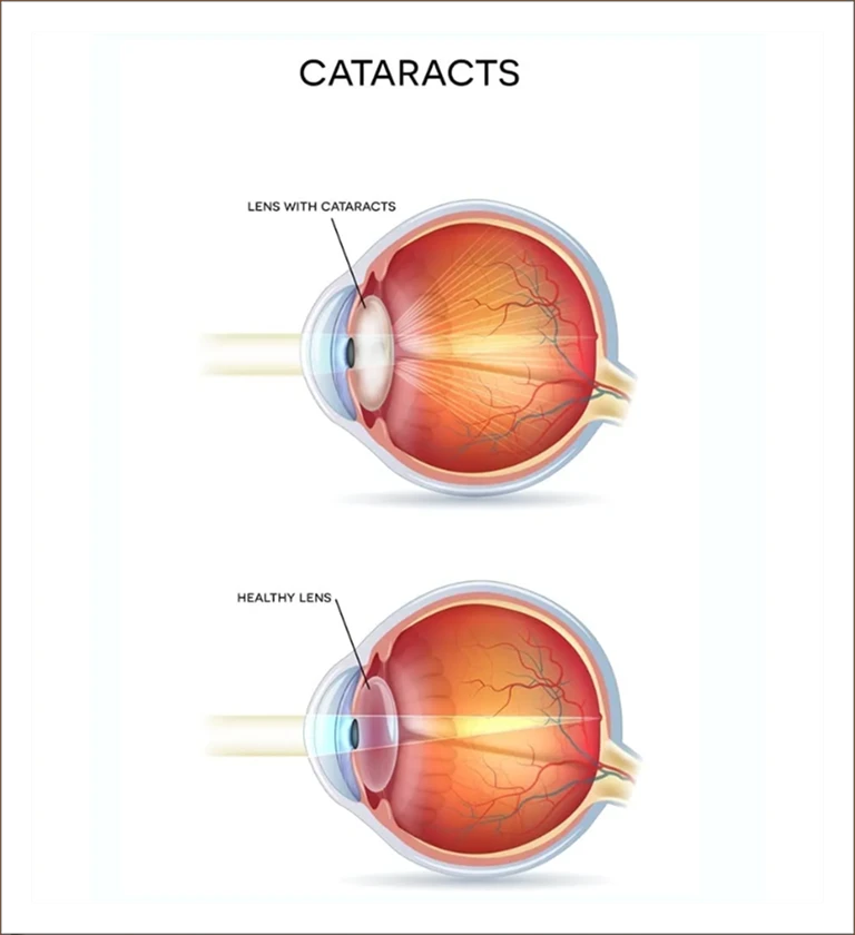 Comparison of cataract and healthy lens