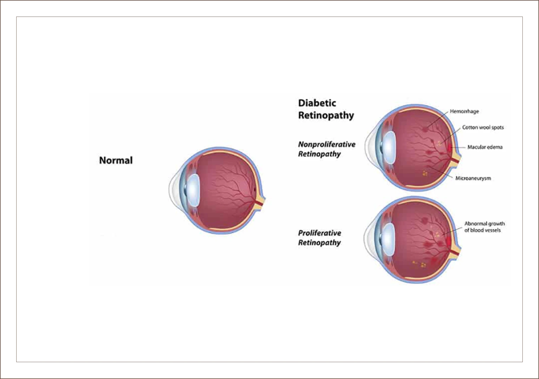Retinopathy stages and symptoms illustrated.