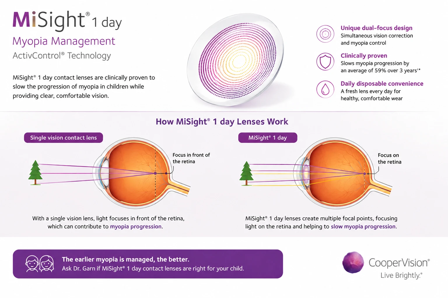 MiSight contact lenses for myopia management diagram.